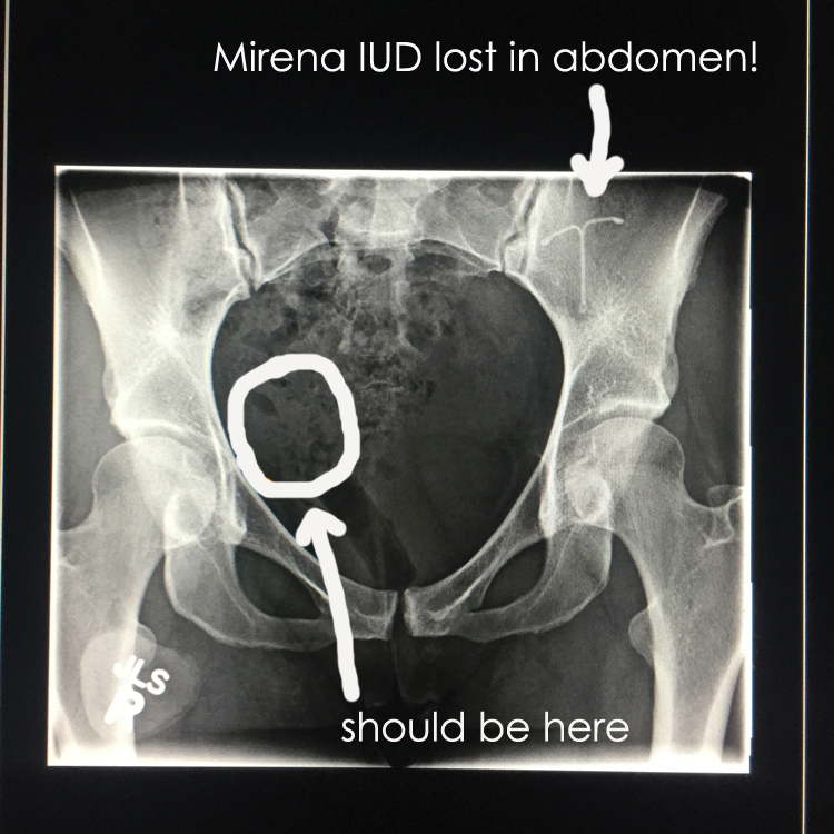 Mirena IUD lost in abdomen